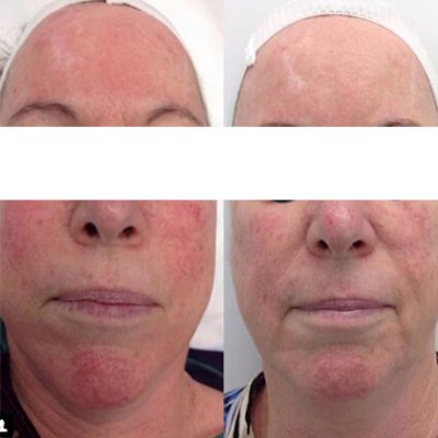 led facial for rosacea