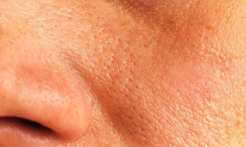 Enlarged Pores - The Cosmetic Clinic