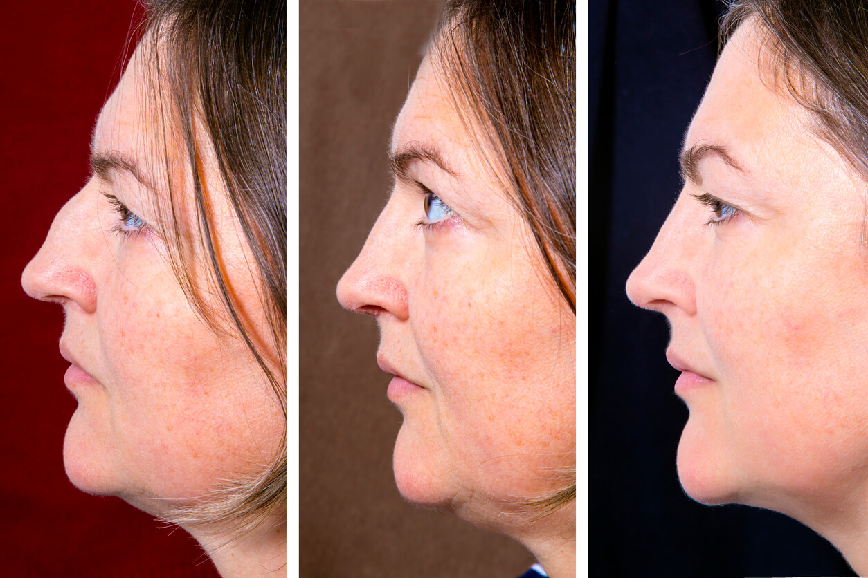 Double Chin Reduction The Cosmetic Clinic