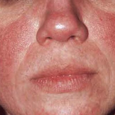 TCC-mild-rosacea