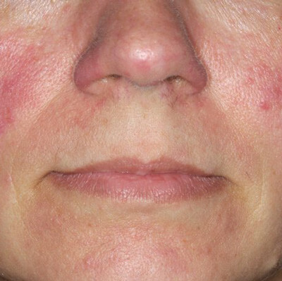 TCC-moderate-rosacea