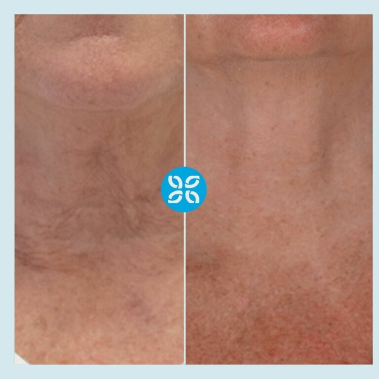 Skin Renew Skin Rejuvenation The Cosmetic Clinic