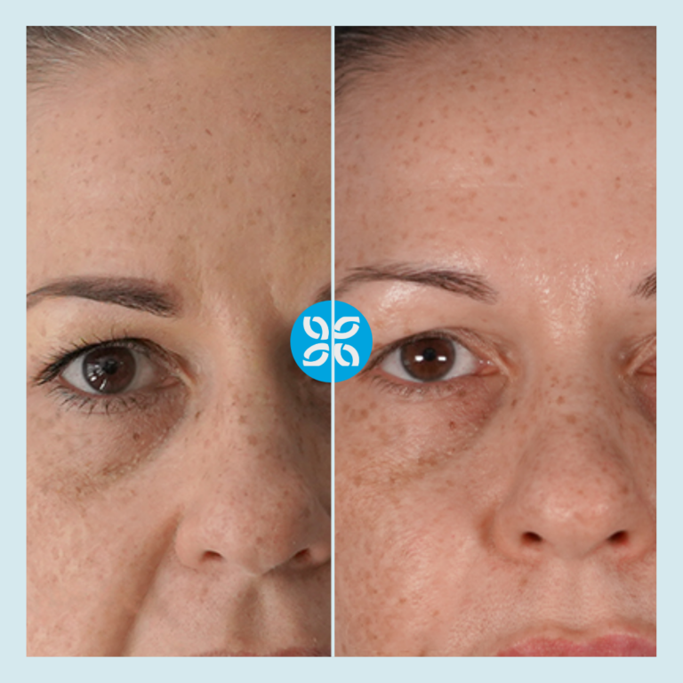 Skin Renew Skin Rejuvenation The Cosmetic Clinic